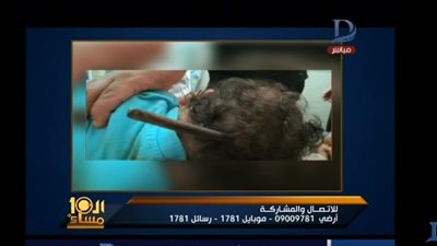 فيديو| عميد كلية طب طنطا: دخول السيخ الحديدي برأس الطفل ليست الحالة الأولى