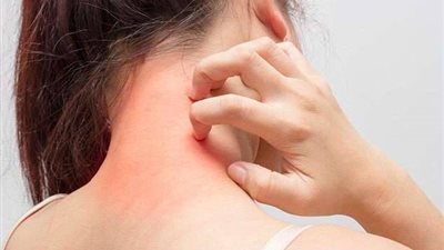 دراسة: مرضى الأكزيما أكثر عرضة للإصابة بأزمات قلبية 