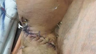 طوارئ دمياط تنقذ يد شاب من البتر بعد إصابتها بـ 