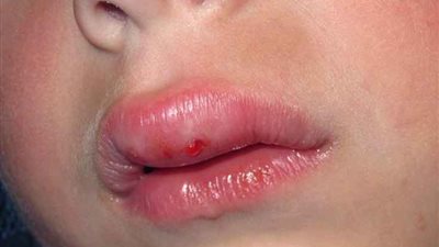 أربع وصفات تخلصك من تورم الشفاه سريعا