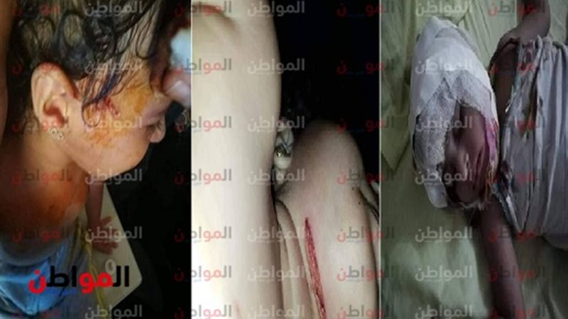 طفلة مصابة 