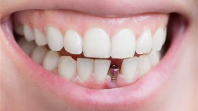 الدكتور كريم مدحت يشرح كل ما يهمك عن زراعة الأسنان