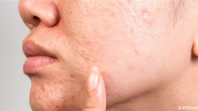 تعرفي على أفضل طرق لـ علاج حفر الوجه
