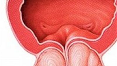 إنفوجراف| 10 أعراض لـ التهاب البروستات