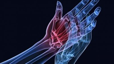 طرق طبيعية لعلاج ارتفاع اليوريك أسيد