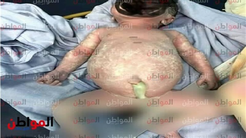 المولودة الحامل في