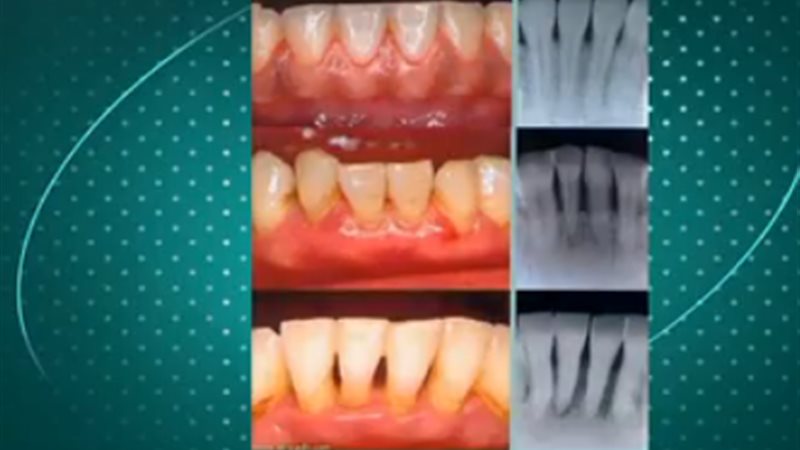 أسباب تراجع اللثة