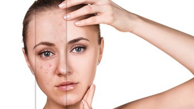 مضيقاك في وشك .. اعرف 3 وصفات طبيعية لعلاج الحبوب