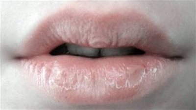 تابع الارصاد الجوية المصرية غدا .. واعرف طرق الحماية من تشقق الشفاه