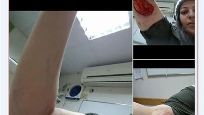 فيديو.. ضحية كلب سيتي ستارز: انا عايزه حقي 
