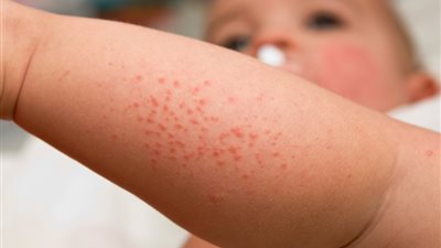 في اليوم العالمى للأكزيما .. 20 ٪ من الأطفال يعانون