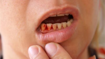 6 أنواع لمرض سرطان الأطفال .. تعرفي على الأعراض 