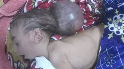 استغاثة| الطفل هشام يعاني إستسقاء بالدماغ ووالدته تناشد أهل الخير