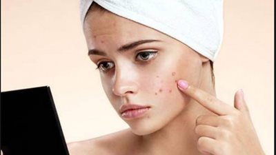مش هتصدق ببلاش..علاج حب الشباب والبثور طبيعيا بهذه الأطعمة