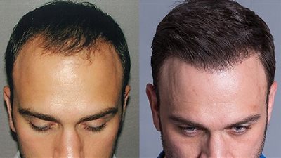 تعرف على أفضل أماكن لعملية زراعة الشعر