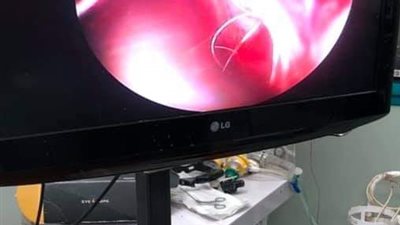 استئصال ورم ضخم بالتجويف الأنفى لمريض بمستشفى قنا الجامعى