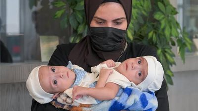 نجاح فصل التوأم السيامي العراقي عمر وعلي بعد عملية جراحية معقدة استغرقت 11 ساعة