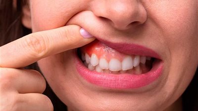 التهاب اللثة .. طبيب أسنان يوضح أسباب الإصابة به وطرق العلاج 